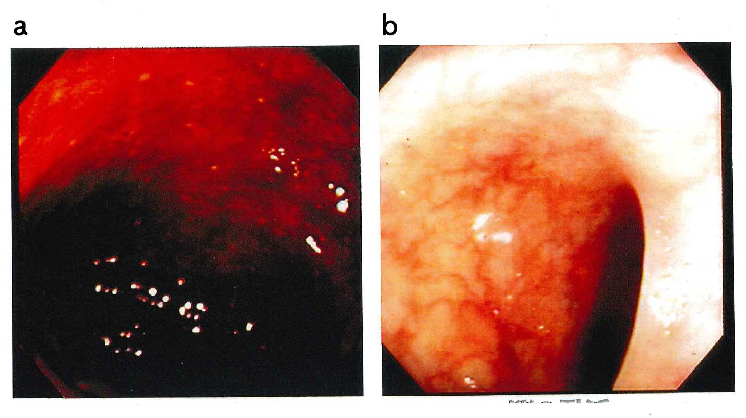 図2　a:大腸黒皮症＝大腸メラノーシス、b：正常者aは大腸粘膜が黒褐色〜黒色を呈している。